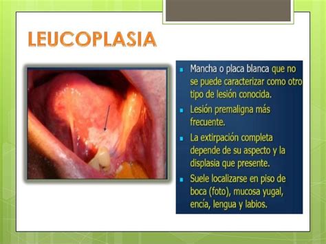 tumores malignos de la cavidad oral