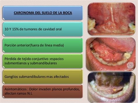 tumores malignos de la cavidad oral