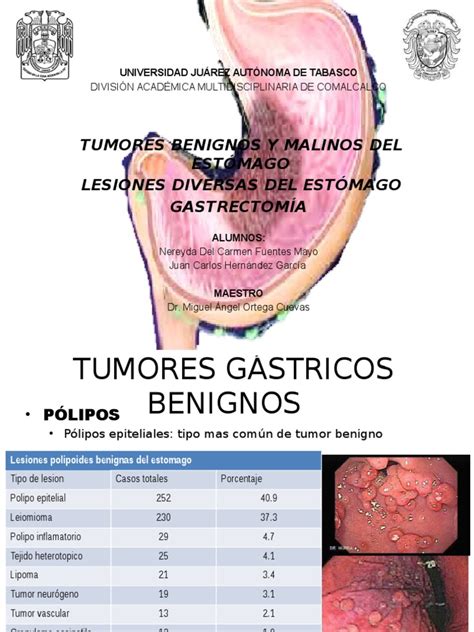 tumores malignos estomago y gastrectomia | Estómago | Metástasis