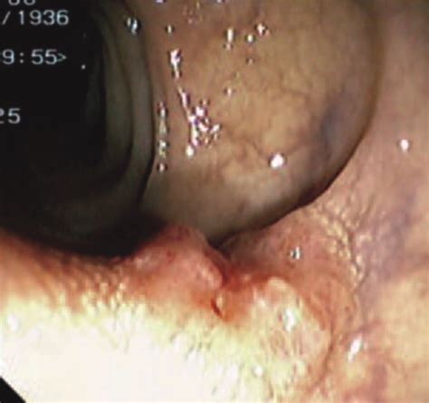 Tumores neuroendocrinos de colon y recto