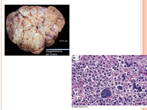 Tumores ováricos de células germinales