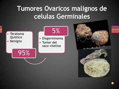 Tumores ovaricos malignos de celulas germinales