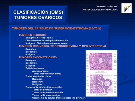 Tumores Ovaricos