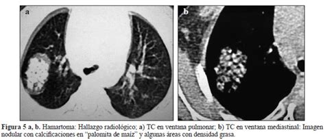 Tumores pulmonares en pediatría