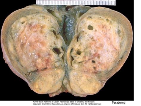 Tumores testiculares patologia 2014