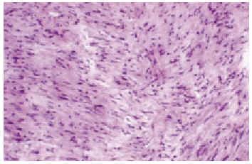Tumores vesicales inusuales: carcinoma epidermoide ...