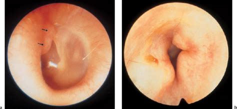 Tumors and Tumor Like Lesions of the External Ear | Ento Key