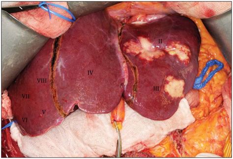 Two stage hepatectomy for liver metastasis from colorectal ...