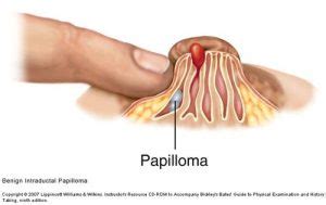 Types of Benign Papilloma and the Most Common Places of ...