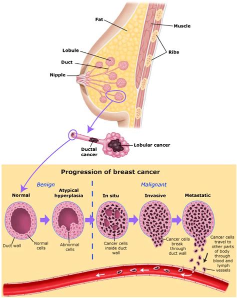 Types of Breast Cancer | John Wayne Cancer Institute