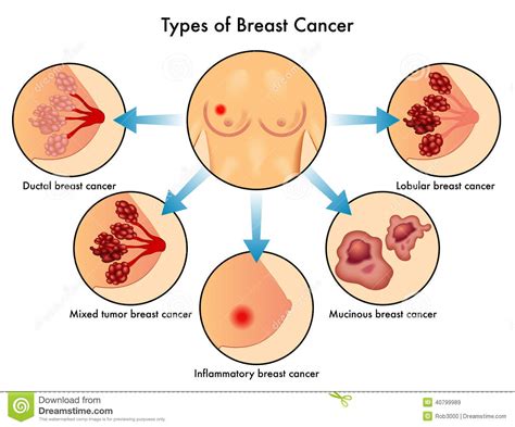Types of Breast Cancer stock image. Image of lobes, cancer ...