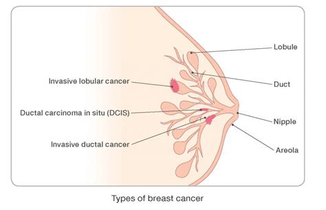 Types of Breast Cancer | Types, Stages & Treatments ...