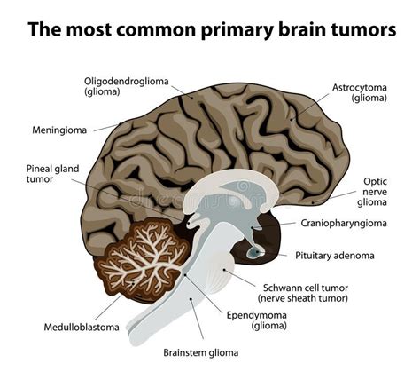 Types Of Cancerous Brain Tumors   Cancer News Update