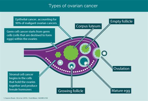 Types of Cancerous Ovarian Tumors – Ovarian Cancer