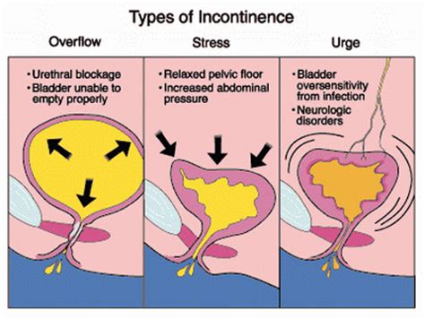 Types Of Incontinence And Causes | Bladder Control Issues
