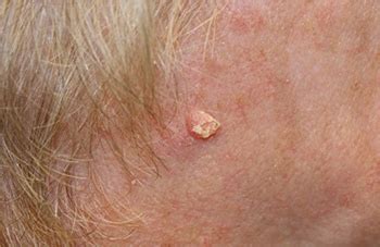 Types of Skin Cancer | Arizona Skin Cancer Specialists