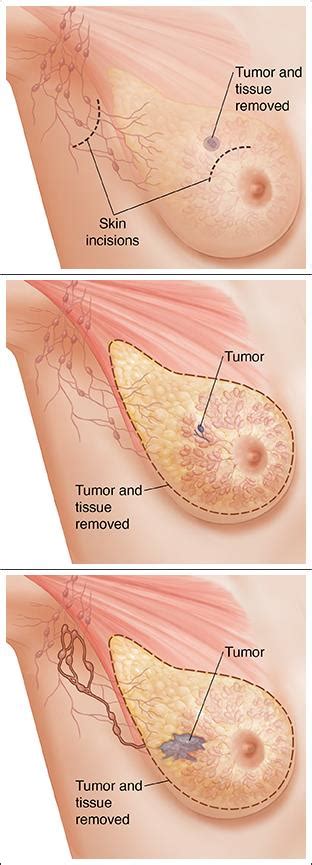 Types of Surgery for Breast Cancer | Articles | Mount ...