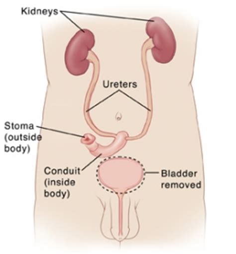 Types of Surgery Ostomy Care & Supply