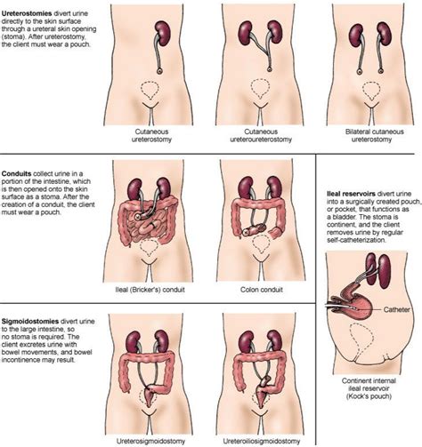 Types of urinary diversions | Nursing RN | Pinterest ...