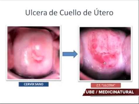 ulcera cuello uterino cervicitis cura total medicina ...
