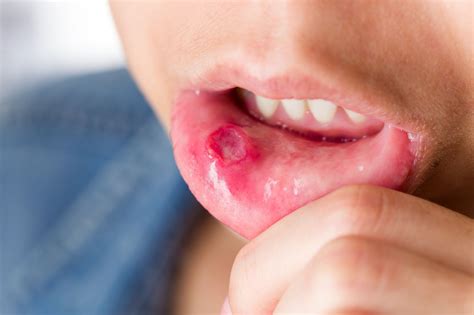 úlceras bucales: Causas, síntomas, tratamiento y más