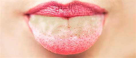 Úlceras en la lengua: 7 causas y tratamiento | La Guía de las Vitaminas