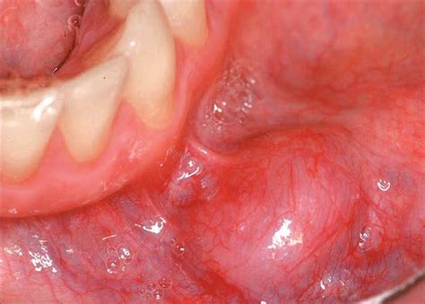 Úlceras y Tumores » Perioclinik