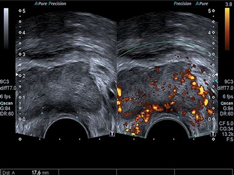 Ultrasonido de próstata   Diagnóstico Especializado por Imagen