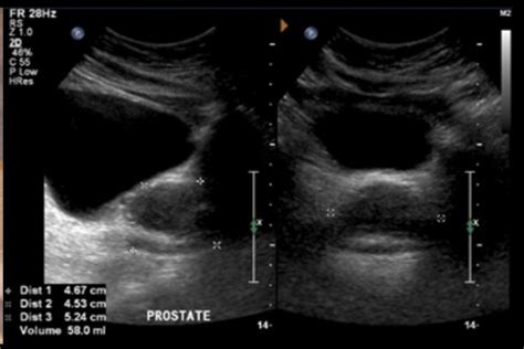 Ultrasonido en el diagnóstico de cáncer de próstata   Médica Capacitación