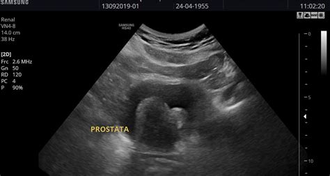 Ultrasonido Prostático | Dr. Emmanuel Acuña