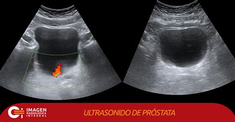 Ultrasonidos prostaticos.