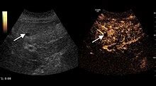 Ultrasonography of liver tumors   Wikipedia