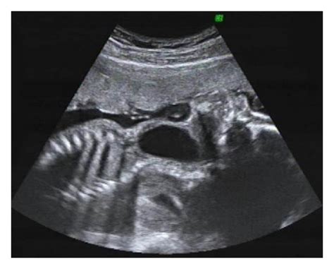 Ultrasound image at 26 weeks’ gestation of a cervical teratoma ...