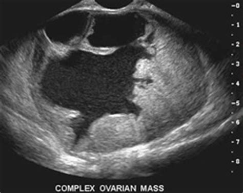 Ultrasound Imaging | CancerQuest