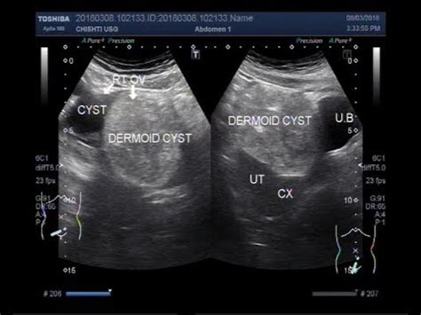 Ultrasound Video showing a simple ovarian cyst and a ...