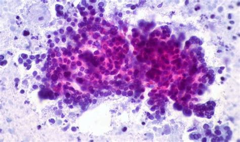 Un ensayo revela nuevos subtipos de cáncer de páncreas