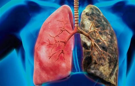 Un estudio español consigue remitir el cáncer de pulmón