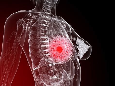 Un gen permite prevenir la metástasis ósea en cáncer de mama