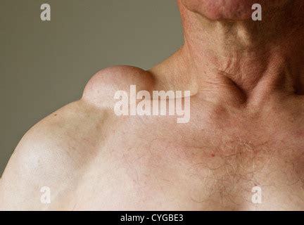 Un lipoma en el hombro de un hombre. El lipoma es un tumor benigno, o ...