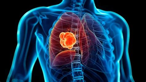 Un nuevo test detecta el cáncer de pulmón cuatro años ...
