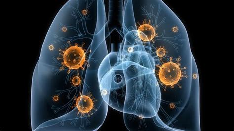 Un nuevo tratamiento reduce el cáncer de pulmón en ocho de ...