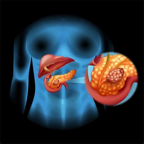 Un serio problema en el páncreas: cáncer   Actitud Saludable