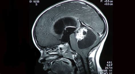 Un tumor cerebral inoperable de una niña desaparece ...