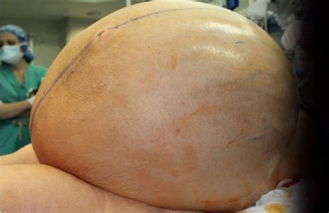 Un tumor de ovario de 60 kg fue extirpado a una mujer ...