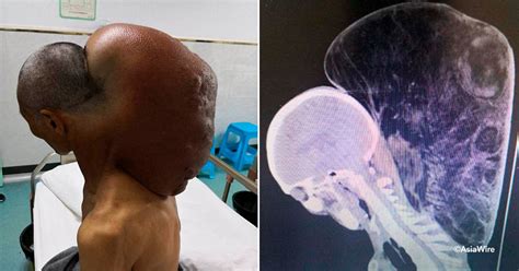 Un tumor masivo en el cuello de un hombre ha sido eliminado después de ...