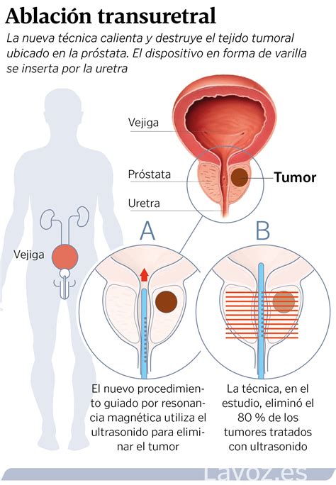Una nueva técnica elimina tumores de próstata con ultrasonidos