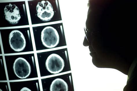Una punción lumbar puede detectar tumores cerebrales