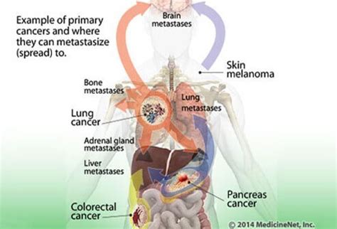 Understanding Cancer: Metastasis, Stages of Cancer, and More