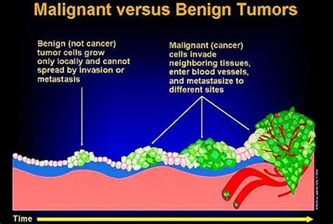 Understanding Cancer Series Part9  Malignant versus Benign ...