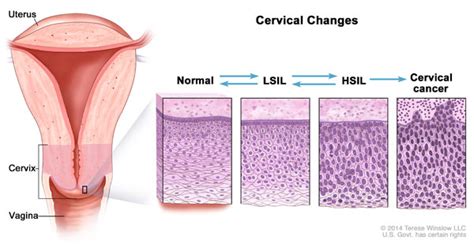 Understanding Cervical Changes: A Health Guide for Women ...